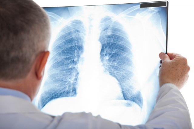 Rak pluća svakog dana dijagnostikuje se kod 16 osoba
